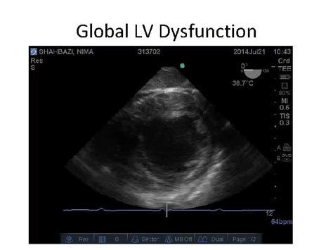 global lv dysfunction